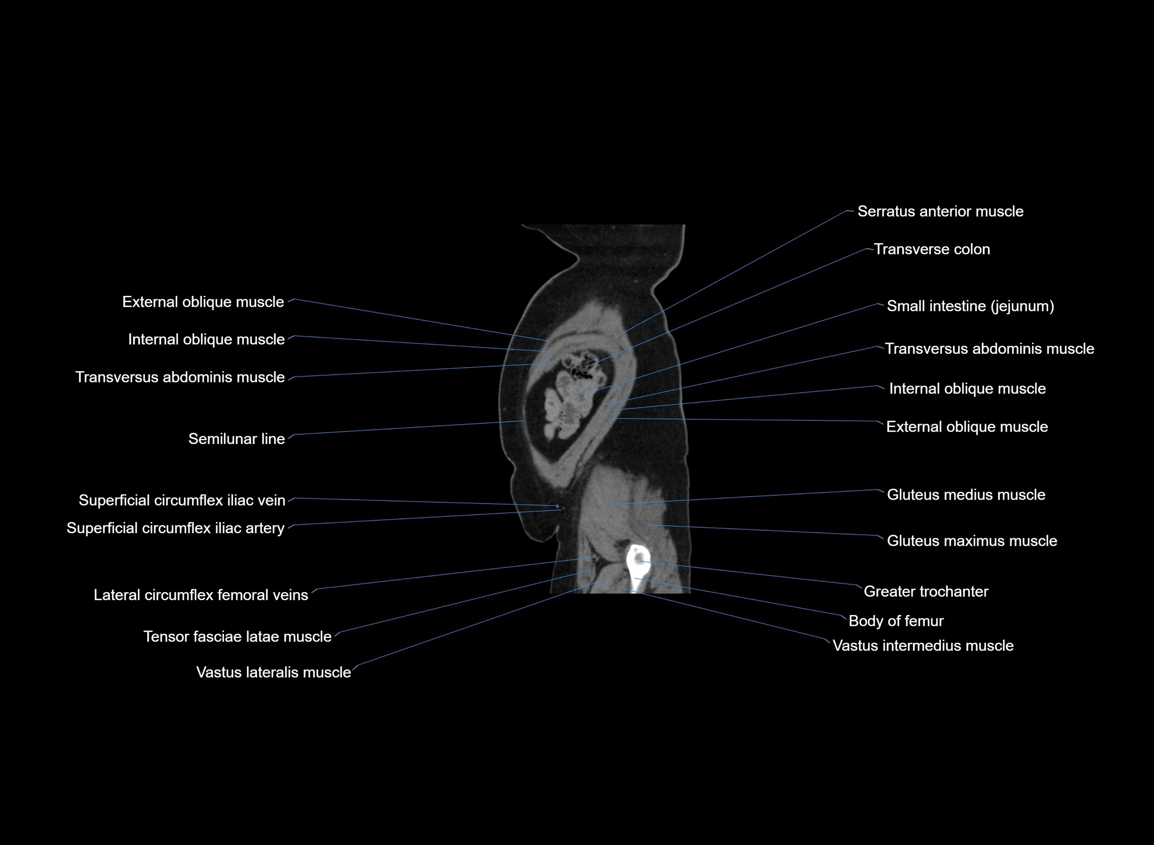 CT Abdomen sagittal cross sectional anatomy labelled radiology image -00011.webp